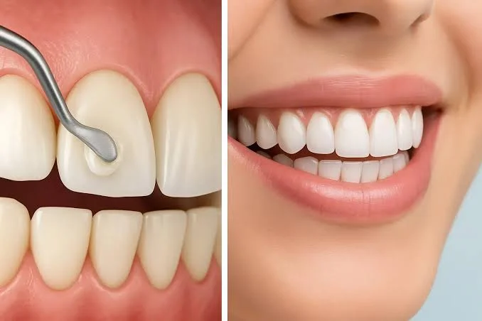آیا امکان ترمیم و پالیش کامپوزیتهای قدیمی وجود دارد؟