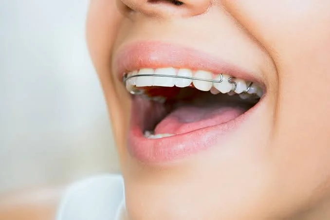 اهمیت استفاده از ریتینر (نگهدارنده)