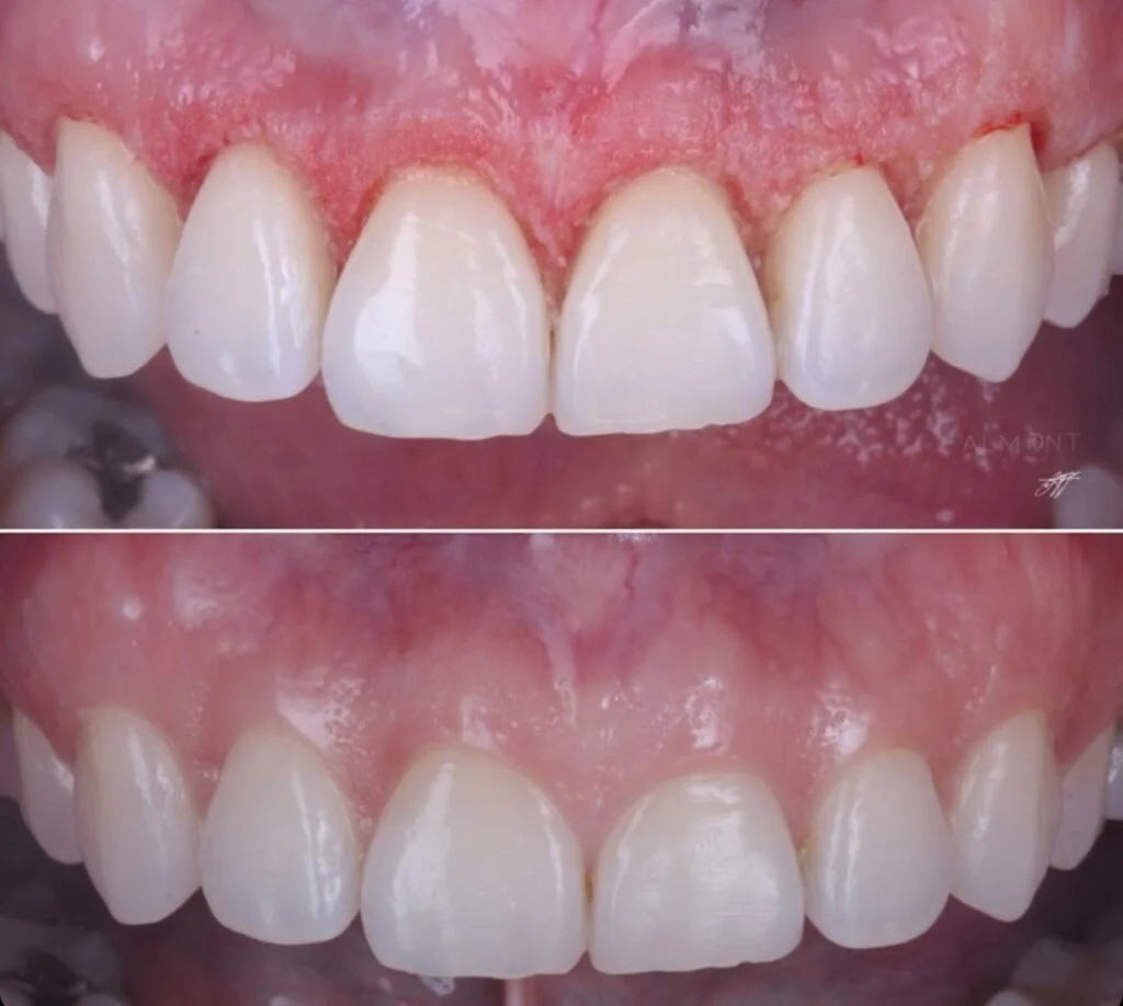 جراحی افزایش طول تاج